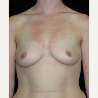 25 year old woman treated with Breast Augmentation before 3103656