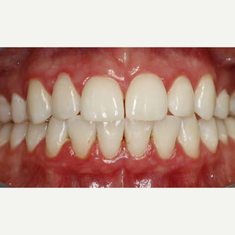 21 year old woman - Teeth Whitening after 3097337