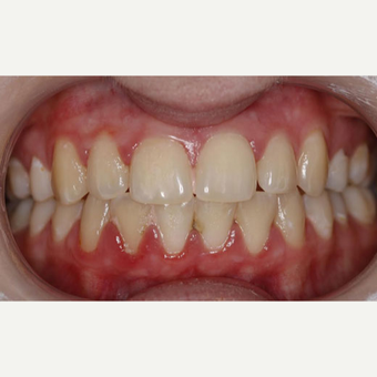 21 year old woman - Teeth Whitening before 3097337