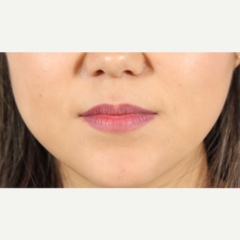 25-34 year old woman treated with Lip Augmentation before 3419606