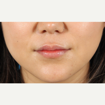 25-34 year old woman treated with Lip Augmentation after 3419606