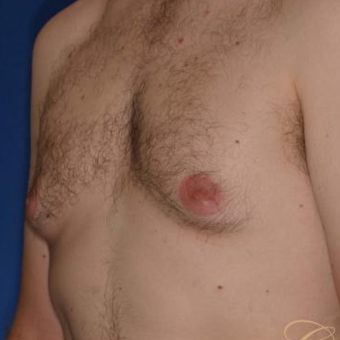 33 year old had male breast reduction surgery before 3502184
