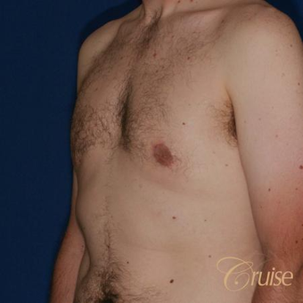 33 year old had male breast reduction surgery after 3502184