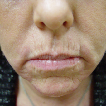 Radiesse and Restylane to Nasolabial Folds, Marionettes and Lips before 2051679