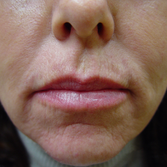 Radiesse and Restylane to Nasolabial Folds, Marionettes and Lips after 2051679