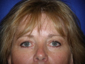 Blepharoplasty after 385221