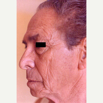65-74 year old man treated with Chemical Peel before 3543699