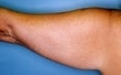 42 year old female patient before 917934
