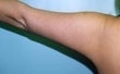 42 year old female patient after 917934