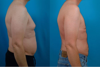 40-year-old man treated with Liposuction. after 574562