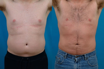 40-year-old man treated with Liposuction. before 574562