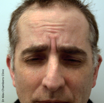 Botox Treatment for Forehead Wrinkles before 947748