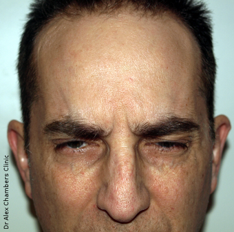 Botox Treatment for Forehead Wrinkles after 947748