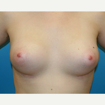 26 year old woman treated with Breast Augmentation after 3486990