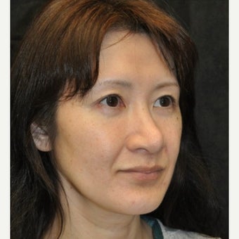 Rhinoplasty before 1772965