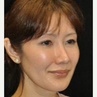 Rhinoplasty after 1772965
