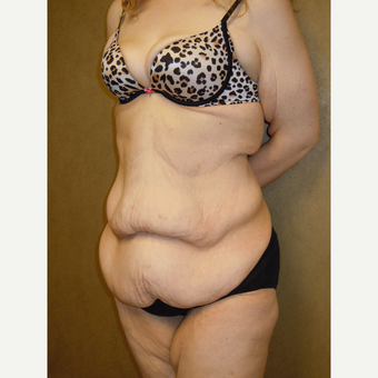 25-34 year old woman treated with Tummy Tuck before 2806550