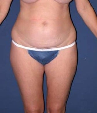 35-44 year old man treated with SAFELipo before 3126330