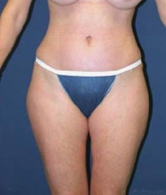 35-44 year old man treated with SAFELipo after 3126330