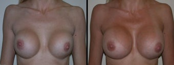 Breast Augmentation before 1231586