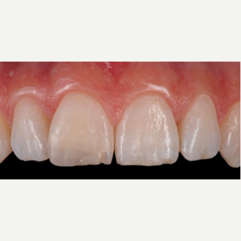 18-24 year old woman treated with Porcelain Veneers before 3428172