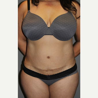 45-54 year old woman treated with Tummy Tuck after 3129174