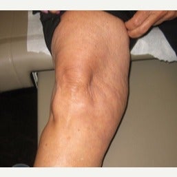 Pre and 3 months post Medial Knee Fat Excision before 2494867