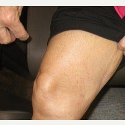 Pre and 3 months post Medial Knee Fat Excision after 2494867