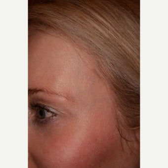 Temple veins treated with Cutera Excel V before 1645973
