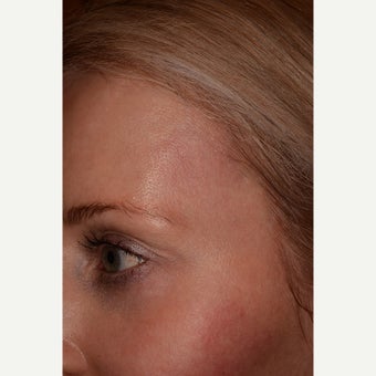 Temple veins treated with Cutera Excel V after 1645973