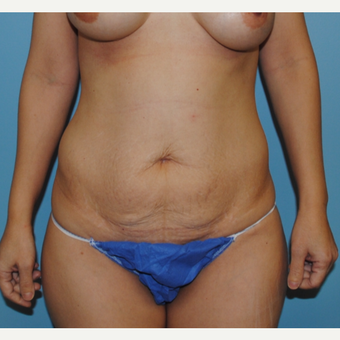 45-54 year old woman treated with Tummy Tuck before 3070839
