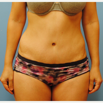 45-54 year old woman treated with Tummy Tuck after 3070839