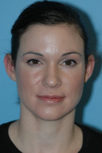 Young female underwent a 12 minute closed tip Rhinoplasty before 986683