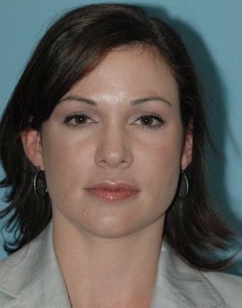 Young female underwent a 12 minute closed tip Rhinoplasty after 986683