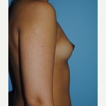 20 Year old with saline 330 cc High Profile implants before 3168660