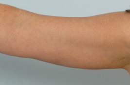Lipodissolve after 935423
