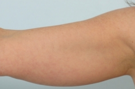 Lipodissolve before 935423