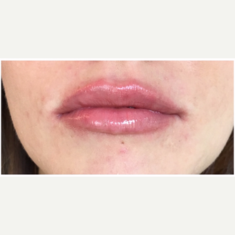 Juvederm Ultra for this 32 year old woman after 3163094