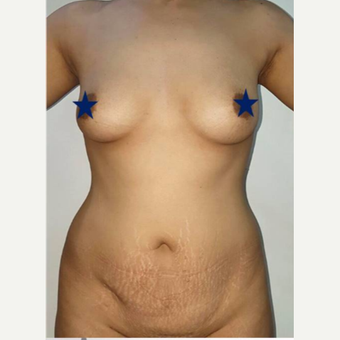 25-34 year old woman treated with Breast Augmentation before 3315060