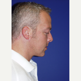 35-44 year old man treated with a Surgical Necklift after 2833982