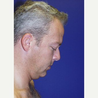 35-44 year old man treated with a Surgical Necklift before 2833982