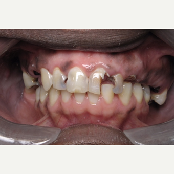 45-54 year old man treated with Dental Implants before 3161993