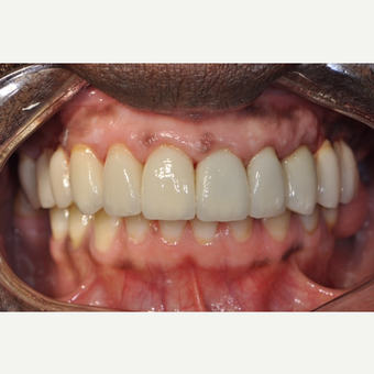 45-54 year old man treated with Dental Implants after 3161993