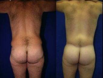 Body Lift before 1322132