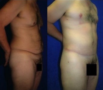 Body Lift after 1322132