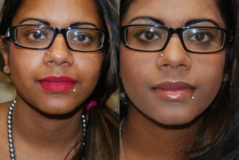 Silikon-1000 lip augmentation. before 1414638
