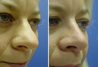 Septorhinoplasty before 1112656