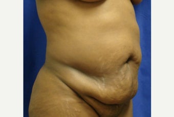 45-54 year old woman treated with Tummy Tuck before 2289331