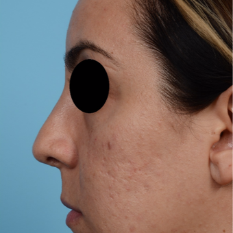 25-34 year old woman treated with Rhinoplasty after 3300075