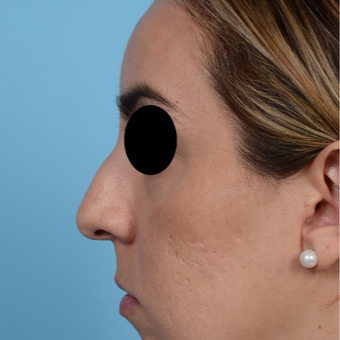 25-34 year old woman treated with Rhinoplasty before 3300075
